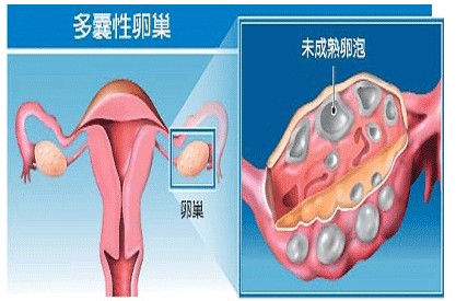 医师：多囊卵巢综合征的合适治疗方法(图1)